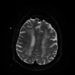 Cerebral embolic infarcts (embolic shower) (Radiopaedia 49837-55108 Axial DWI 15).jpg