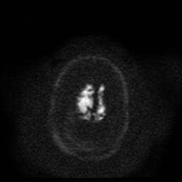 Cerebral embolic infarcts (embolic shower) (Radiopaedia 49837-55108 Axial DWI 50).jpg