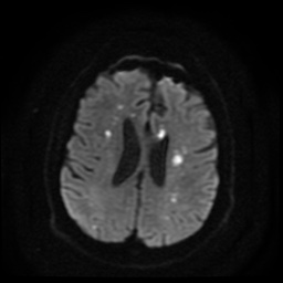 Cerebral embolic infarcts (embolic shower) (Radiopaedia 49837-55108 Axial DWI 65).jpg