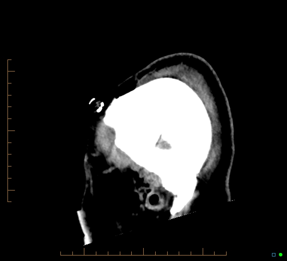 Cerebral fat embolism (Radiopaedia 85521-101224 C 49).jpg