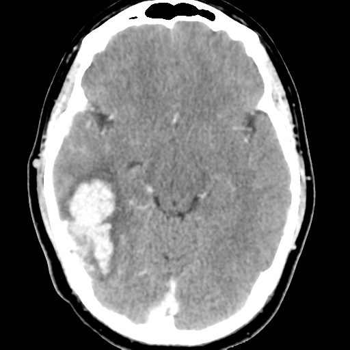 Cerebral hemorrhage secondary to arteriovenous malformation (Radiopaedia 33497-34561 B 23).png