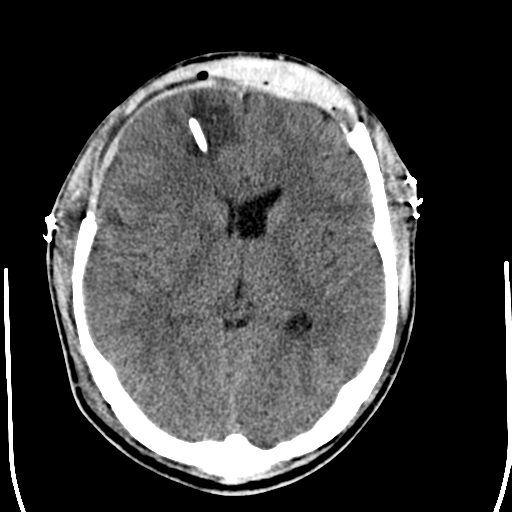 File:Cerebral hemorrhagic contusions- temporal evolution (Radiopaedia 40224-42755 AXIAL THICK 16).png