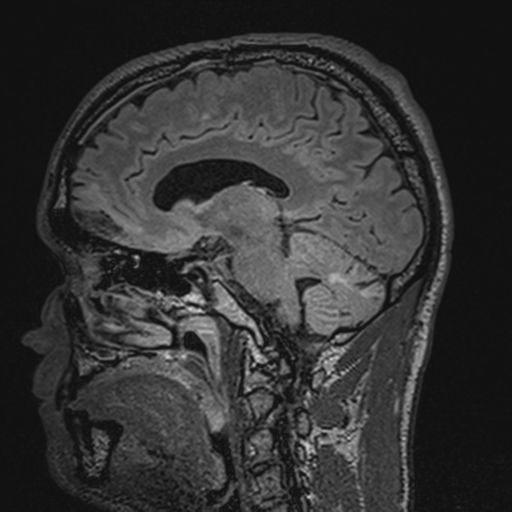 File:Cerebral hemorrhagic contusions- temporal evolution (Radiopaedia 40224-42757 Sagittal T1 36).png