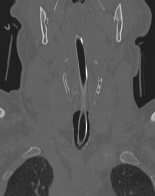 Cerebral hemorrhagic contusions and cervical spine fractures (Radiopaedia 32865-33841 Coronal bone window 9).jpg