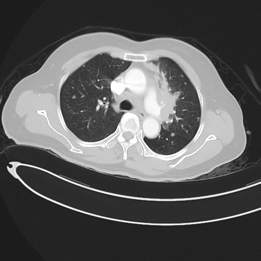 File:Cerebral metastases (Radiopaedia 33041-34055 Axial lung window 20).png