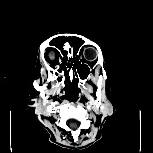 File:Cerebral metastases - breast primary (Radiopaedia 77653-89857 Axial C+ delayed 7).jpg