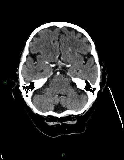 Cerebral metastases - ependymal and parenchymal (Radiopaedia 79877-93131 Axial C+ delayed 22).jpg