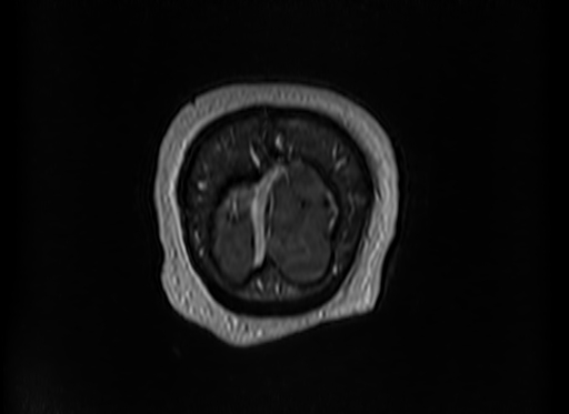 File:Cerebral metastases from lung cancer with amyloid angiopathy and cerebellopontine angle meningioma (Radiopaedia 74306-85191 Coronal T1 C+ 61).jpg