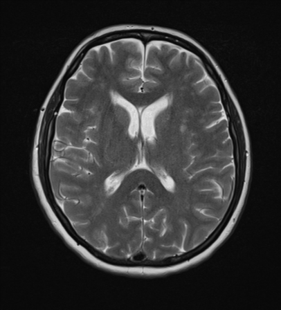 File:Cerebral metastases mimicking abscesses (Radiopaedia 45841-50131 Axial T2 17).png