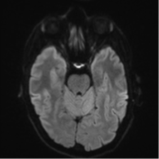File:Cerebral metastasis - melanoma (Radiopaedia 54718-60954 Axial DWI 41).png