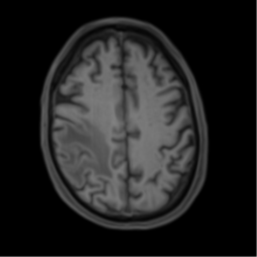 Cerebral metastasis - melanoma (Radiopaedia 54718-60954 Axial T1 39).png