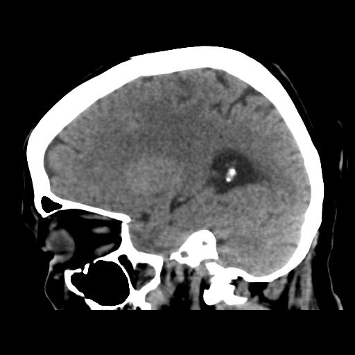 Cerebral metastasis to basal ganglia (Radiopaedia 81568-95412 E 41).png