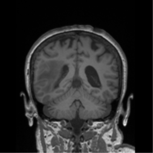 Cerebral metastasis to basal ganglia (Radiopaedia 81568-95413 Coronal T1 12).png