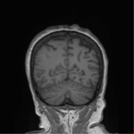 File:Cerebral metastasis to basal ganglia (Radiopaedia 81568-95413 Coronal T1 2).png