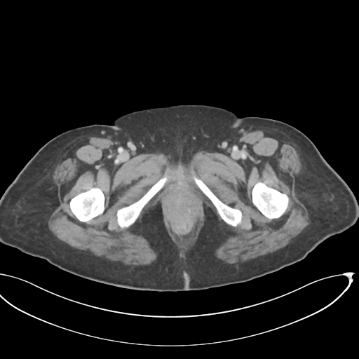 Cerebral metastasis to basal ganglia (Radiopaedia 81568-95414 E 82).png