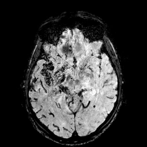 Cerebral parenchymal arteriovenous malformation (Radiopaedia 27280-27456 Axial SWI 47).jpg