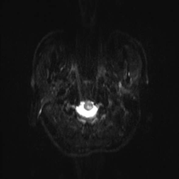 Cerebral toxoplasmosis (Radiopaedia 53993-60132 Axial DWI 1).jpg