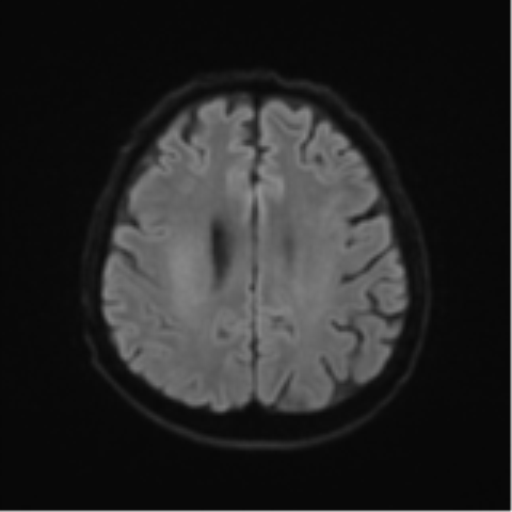 Cerebral toxoplasmosis (Radiopaedia 54575-60804 Axial DWI 55).png