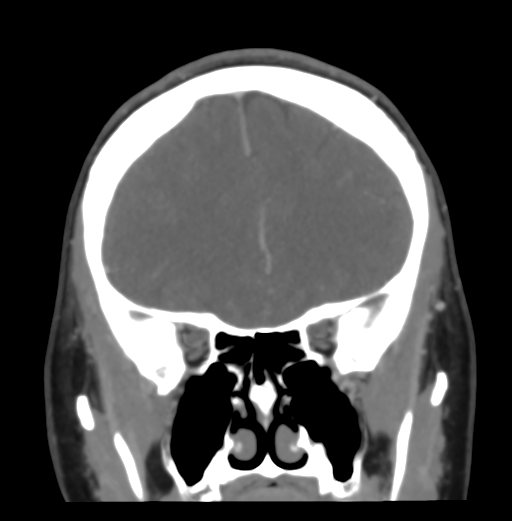 Cerebral venous hemorrhagic infarction (Radiopaedia 38461-40550 Coronal MIP VENOGRAM 18).png