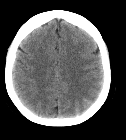 File:Cerebral venous infarction due to transverse sinus thrombosis (Radiopaedia 34688-36116 Axial non-contrast 19).png