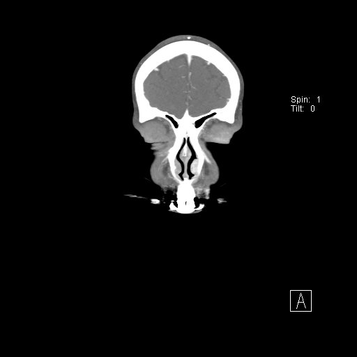 Cerebral venous infarction with hemorrhage (Radiopaedia 65343-74396 B 21).jpg