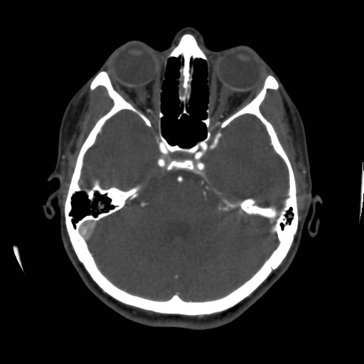 Cerebral venous sinus thrombosis (Radiopaedia 40619-43227 A 69).jpg