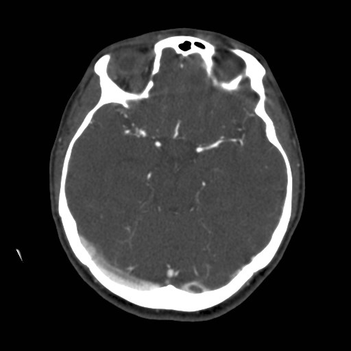 Cerebral venous sinus thrombosis (Radiopaedia 40619-43227 A 88).jpg