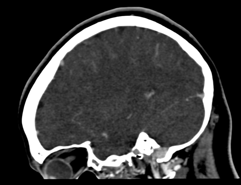 Cerebral venous sinus thrombosis (Radiopaedia 59224-66646 Sagittal C+ delayed 5).jpg
