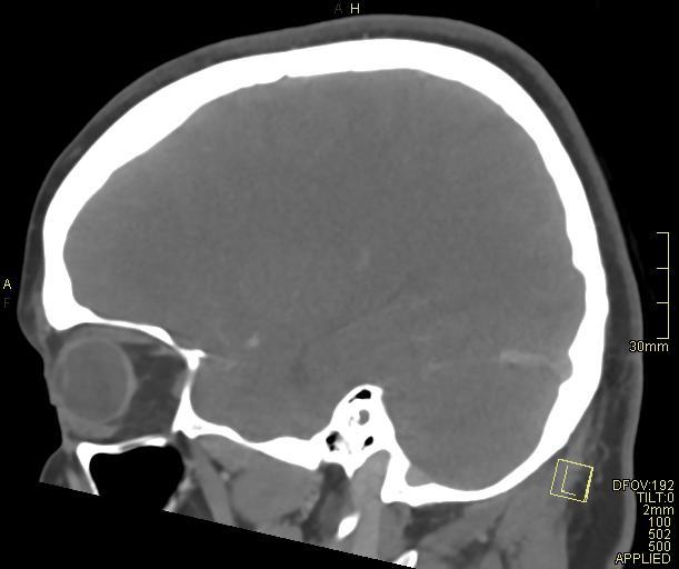 File:Cerebral venous sinus thrombosis (Radiopaedia 91329-108965 Sagittal venogram 24).jpg