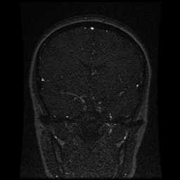 Cerebral venous thrombosis - ulcerative colitis (Radiopaedia 66049-75219 Coronal MRV 72).jpg