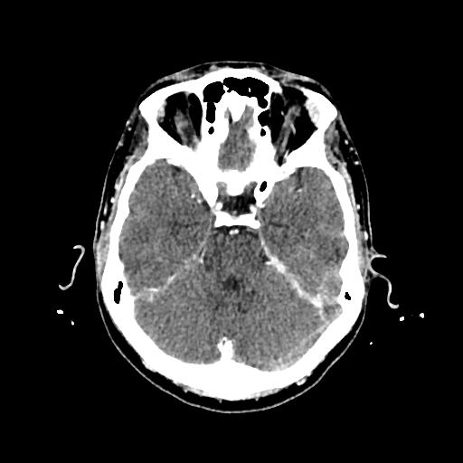 Cerebral venous thrombosis with venous hemorrhagic infarct (Radiopaedia 90354-107660 Axial with contrast 57).jpg