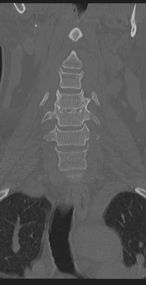 Cervical canal stenosis due to ossification of the posterior longitudinal ligament (Radiopaedia 47260-51823 Coronal bone window 16).png