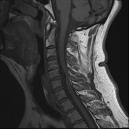 File:Cervical canal stenosis due to ossification of the posterior longitudinal ligament (Radiopaedia 47260-51824 Sagittal T1 8).png