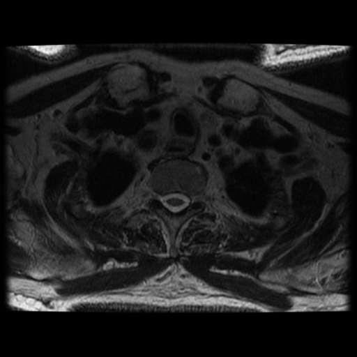 File:Cervical canal stenosis with cord compression (Radiopaedia 34114-35374 Axial T2 7).png