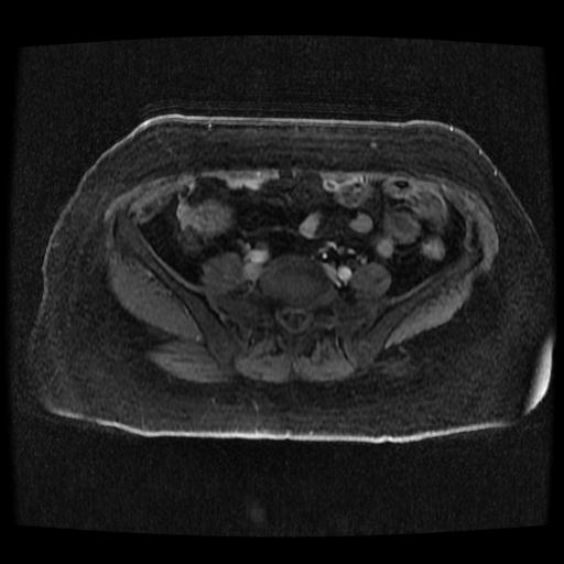 Cervical carcinoma (Radiopaedia 70924-81132 Axial T1 C+ fat sat 79).jpg