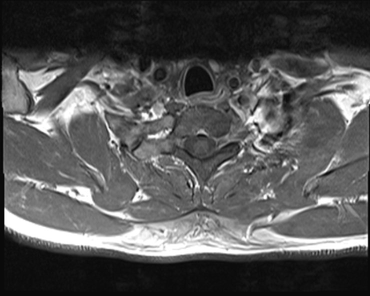 File:Cervical disc extrusion (Radiopaedia 53950-60077 Axial T1 C+ fat sat 28).jpg