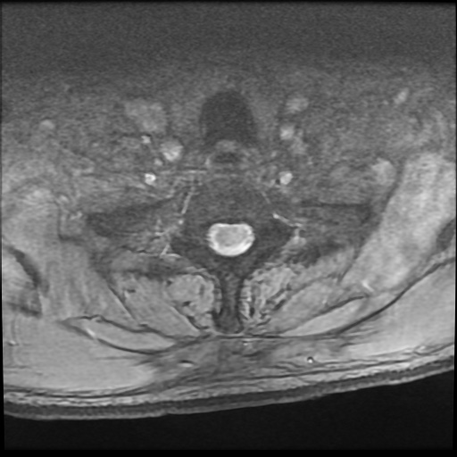 Cervical disc extrusion (Radiopaedia 59074-66364 F 60).jpg