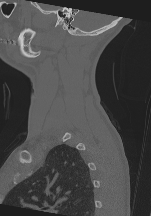 Cervical intercalary bone (Radiopaedia 35211-36748 Sagittal bone window 71).png