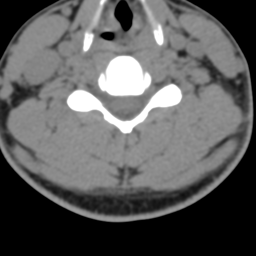 Cervical schwannoma (Radiopaedia 57979-64974 Axial non-contrast 39).png