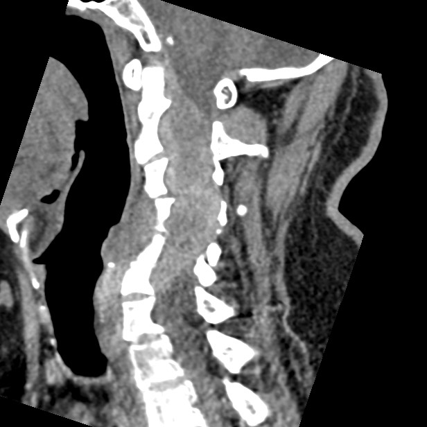Cervical spinal neurofibroma in a patient with NF1 (Radiopaedia 58344-65464 C 24).jpg