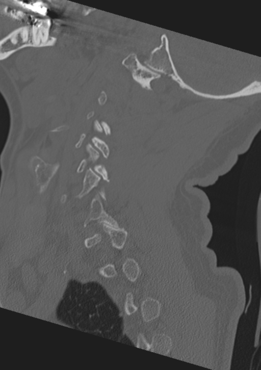 Cervical spine fractures with vertebral artery dissection (Radiopaedia 53296-59268 Sagittal bone window 17).png