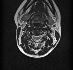 File:Cervical spondylodiscitis and calvarial hemangioma (Radiopaedia 64317-73104 Axial T2 1).jpg