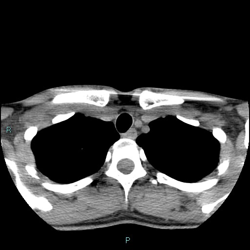 File:Cervical thymic cyst (Radiopaedia 88632-105335 Axial non-contrast 22).jpg