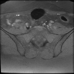 File:Cesarean scar ectopic pregnancy (Radiopaedia 77286-89362 Axial T1 fat sat 3).jpg