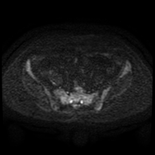 File:Cesarian section scar endometriosis (Radiopaedia 66520-75799 Axial DWI 79).jpg