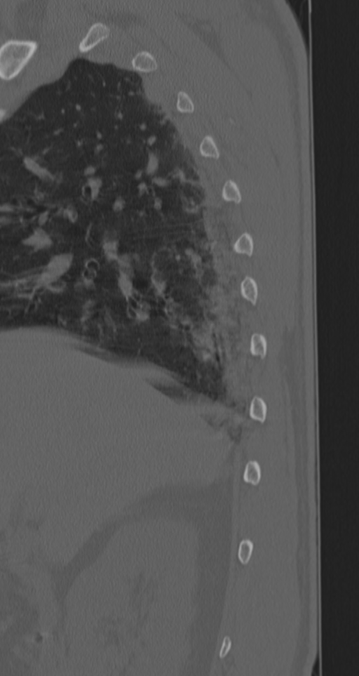 Chance fracture (Radiopaedia 33854-35020 Sagittal bone window 82).png