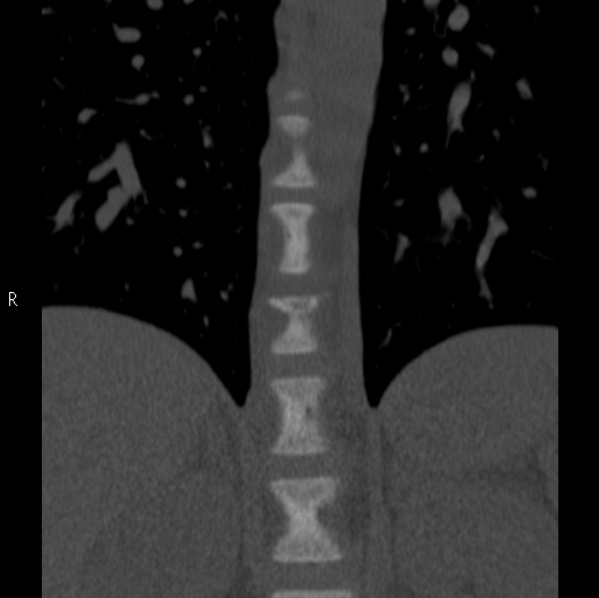 File:Chance fracture (Radiopaedia 36521-38081 Coronal bone window 5).jpg