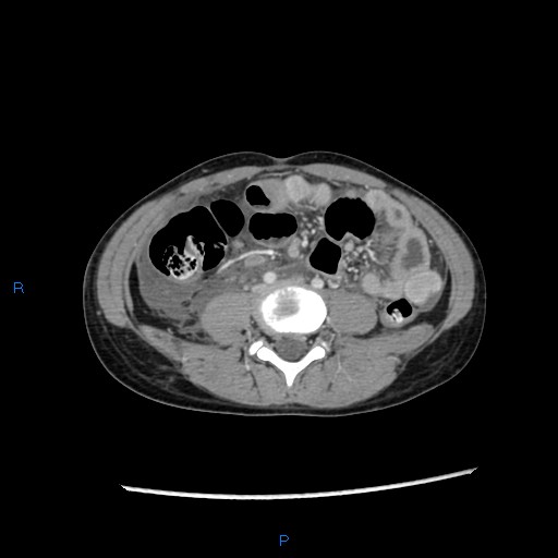 File:Chance fracture with duodenal and pancreatic lacerations (Radiopaedia 43477-46864 A 33).jpg