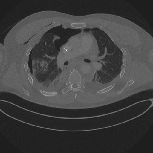 File:Chest multitrauma - aortic injury (Radiopaedia 34708-36147 Axial bone window 136).png