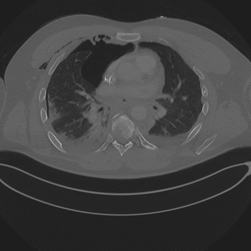 Chest multitrauma - aortic injury (Radiopaedia 34708-36147 Axial bone window 153).png